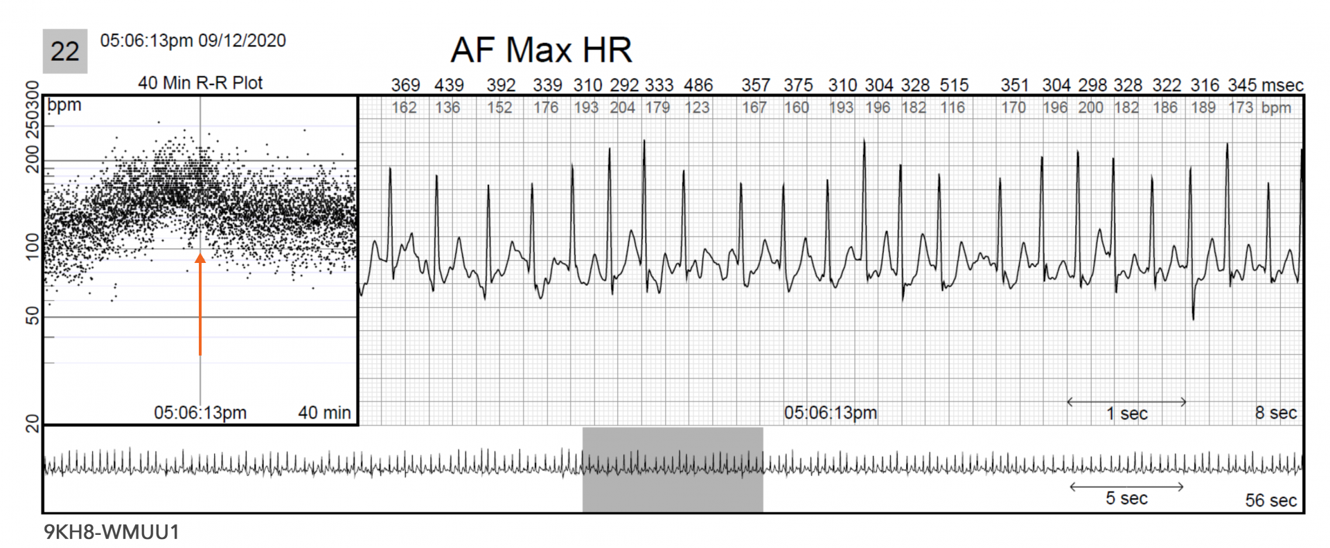 case study for atrial fibrillation