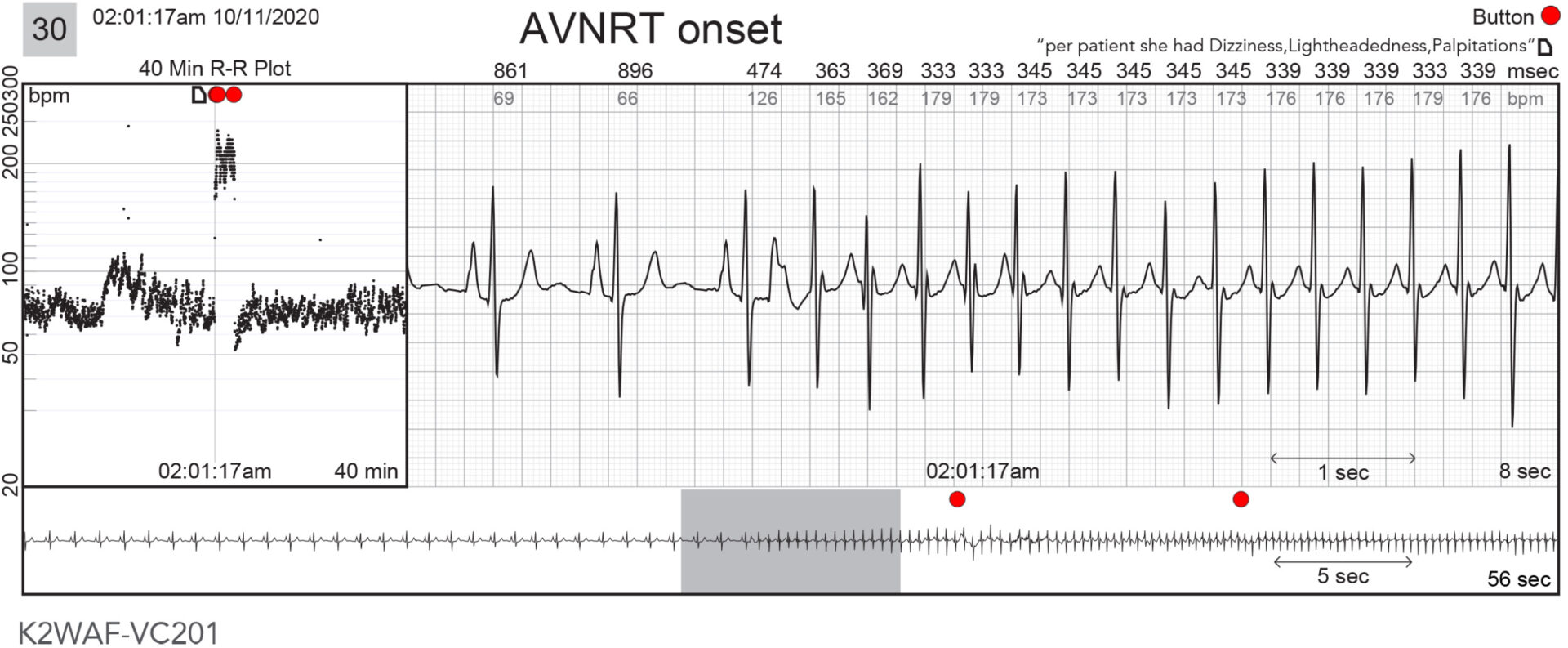 US-FLC199-220030 Atrioventricular Nodal Reentrant Tachycardia Case ...