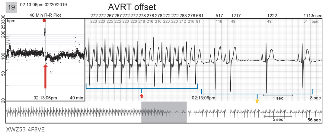 US-FLC199-230030 AV Reentrant Tachycardia Case Studies | BardyDx